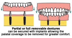 Full or Partial Dentures