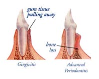 Diagram of the ADA early warning signs of gum disease