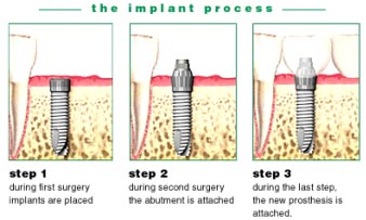 The Implant Process