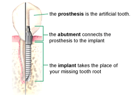 Implant Diagram