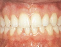 Healthy Gums and teeth